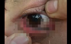 閲覧注意！トレッキング中、目の中にヒルが入り込む