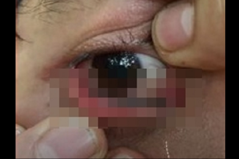 閲覧注意！トレッキング中、目の中にヒルが入り込む